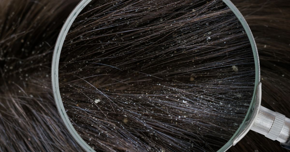 how to know if you have lice or dandruff